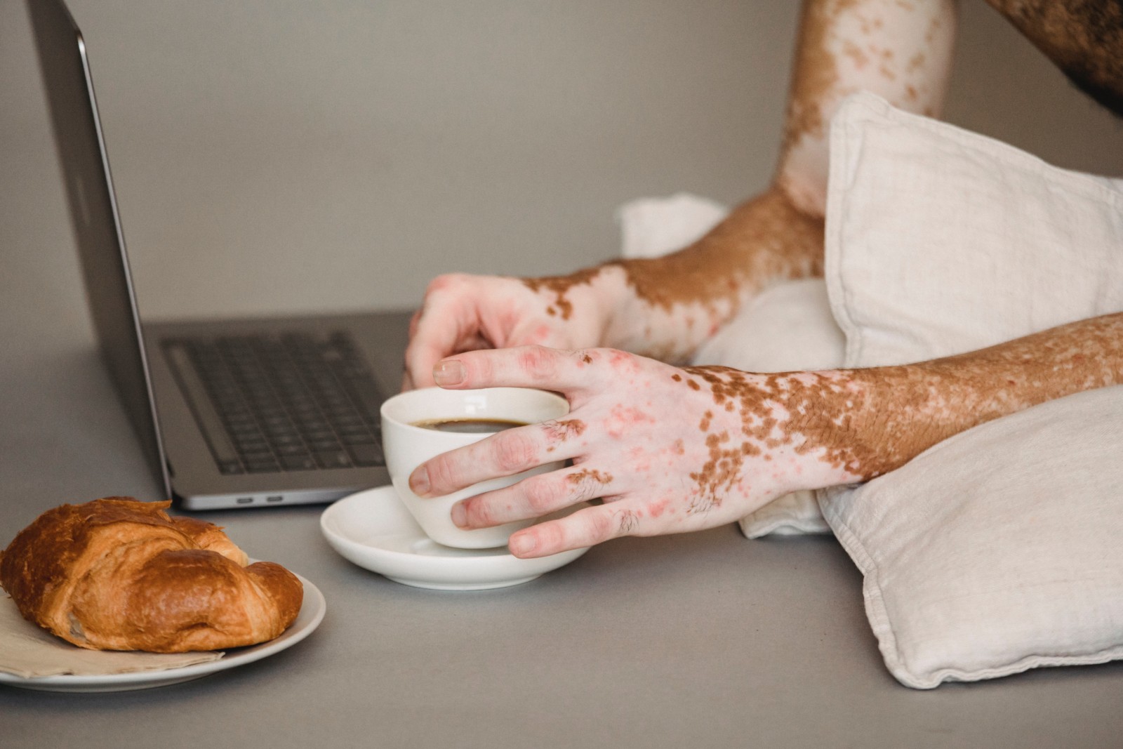 Osoba s vitiligem drží bílý šálek kávy při práci na notebooku v posteli. Nedaleko je croissant na malém talířku. Bílé polštáře a povlečení vytvářejí útulnou, uvolněnou atmosféru a nabízejí klidné prostředí, které může pomoci při zmírnění příznaků autoimunitní nemoci.