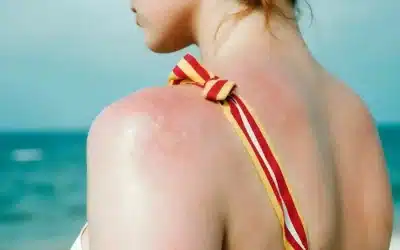 SLUNEČNÍ ALERGIE – SLUNCE V ROLI NEPŘÍTELE?